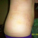 Side view 3 weeks post-op
