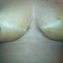 5 days post op