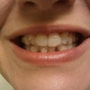 Aligners 15