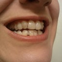 15 - Right side. not sure why my canine looks so discolored, it doesnt look that way without the aligner in.