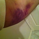 post op day 1, My arm right after surgery, it was bruised badly for about a month afterwards, its gone now!
