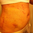 post op day 1, my stomach was a lil bruised, extremely sensitive and sore, and really swollen!