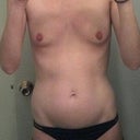Before Surgery - 34AA
