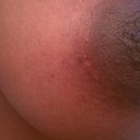 Breast scar - 4 months