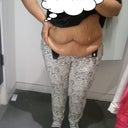 Pre-Op Pic#3.... I know I know.... I really need a TT and some Serious Lipo.... Im Working on Loosing Weight!!! lol