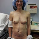 Pre-surgery, with my markings.