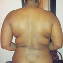 taken the night before my procedure. picked up weight since TT but am losing the weight. Fat deposits on my back and arms.