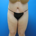 This is the exact same angle as the before picture about 6 weeks post surgery.