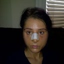 Recovery-2 days after surgery