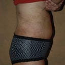 Day 3 Post Op Right