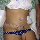 after surgery.