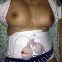 after surgery.