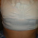 One day post-op