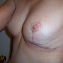 8 weeks post-op, I feel great!