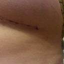 9 days post op
