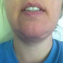 11 Weeks Post Op. Here you can see my chin puckers that are on either side of my incision. REALLY hoping these go away when the swelling in that area is gone.