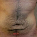 Pre Op - This was about 12 months ago, you can really see the excess skin in this photo.