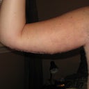 POD 9  Right Arm Front