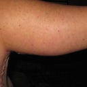 POD 9 Right Arm Back