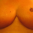 Day 16 Post Op.