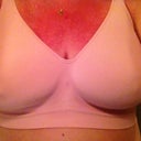 Day 18 Post Op.