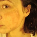 2nd treatment 3 months+ after the 1st. stronger peel-about 20-25%