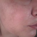 one side is not as burned as the other side of my face