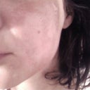 burned side, you can see the spot on my high cheak bone where it is beginning to peel prematurely.It might leave a scar. I scratched during the night unintentionally.  