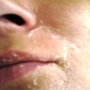1st time peel- notice the thickness of the skin that is peeling off