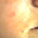 1st time peel-15%-5 days in