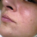 here is a good pic of how tight, dry and aligator like your skin will get.Skin has only began to peel around my mouth, not my cheeks or forehead.