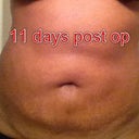 Swelling is going down but there's lumpy areas I have to watch out for and massage more