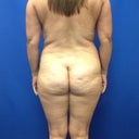 Before surgery picture