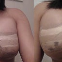 day 1 and day 2 post op