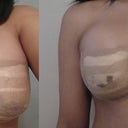 day 1 and day 2 post op