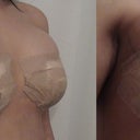 day 1 and day 2 post op
