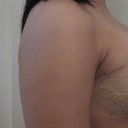 day 1 and day 2 post op