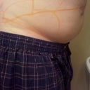 The night after my first consultation when she  made markings