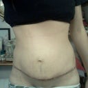 Day 13-Looking MORE bloated :( Might be cause I started my period this morning AND I've been eating more normaly. Scar is starting to scab over tho