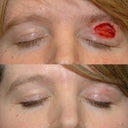 Top photo: Immediately after Mohs surgery
Bottom photo: Approx. 4 months after reconstruction