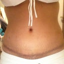 Scar 2 Weeks started bio oil and Mederma and tape