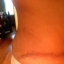 My right side scar sticks out ...hope it smooths out