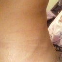 Left hip flat