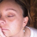 This is a picture of my eye up close 1 month after.  I have just very small bruise under both eyes no more swelling and the scar you can almost not even feel at this point!  But I do put cream on it!