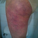 After 20 hours, pretty typical bruising for me. You can see the little incision, shallow,  no stitches.  Not painful, just colorful.