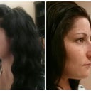 Right- before (obviously), Left- 1 week post op, still swollen but much improved.
