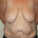pre-op