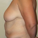 pre-op