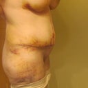 1 week post op (i had to take the picture myself so it's a weird angle)