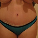 6 weeks post op